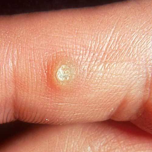 Warts on Finger | Warts Pictures - Amoils.com