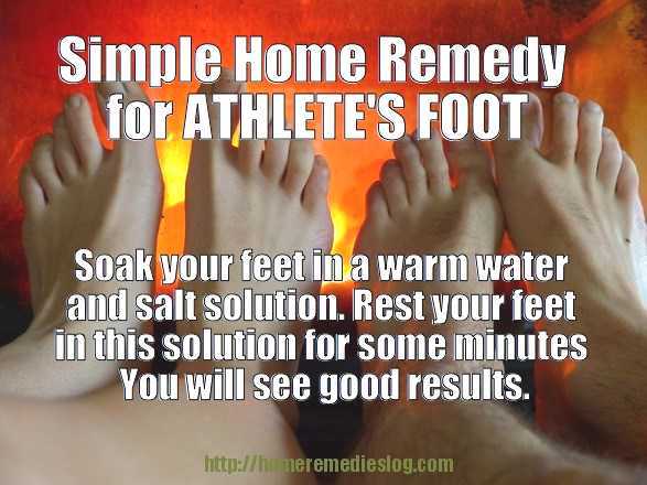 The Athletes Foot Cures – Sure Ways to Cure This Painful Foot Fungus