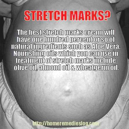 Best Stretch Mark Cream – The Essential Qualities To Look For