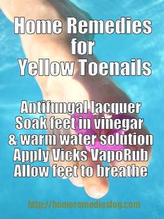 Yellow Toenails – Onychomycosis