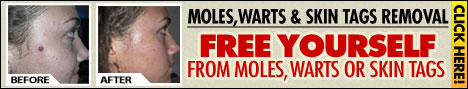 Moles, Warts & Skin Tags Removal