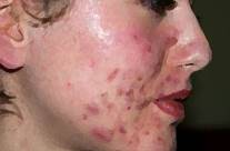 How Scars from Acne Affect Emotional & Mental Health