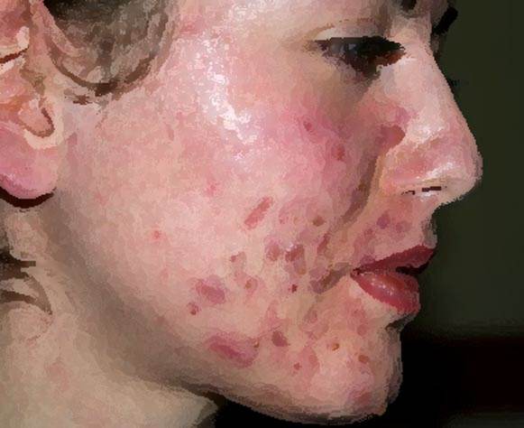 How Scars from Acne Affect Emotional & Mental Health