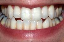 Home Remedies to Whiten Teeth – Secrets of Nature