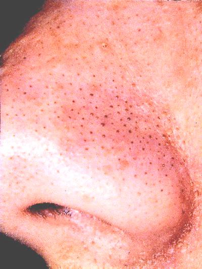 blackheads on the nose