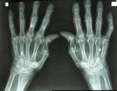 Xray of arthritic hands
