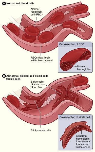 Sickle_cell_Anemia