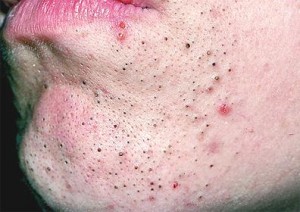 blackheads on face