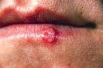 Home Remedies for Cold Sores – Controlling the Herpes Virus Lip Blister