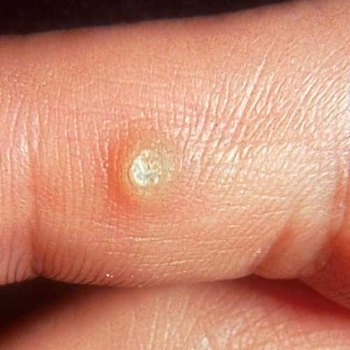 wart on finger