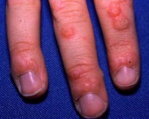 Warts on fingers